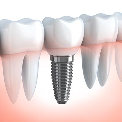 dental implants