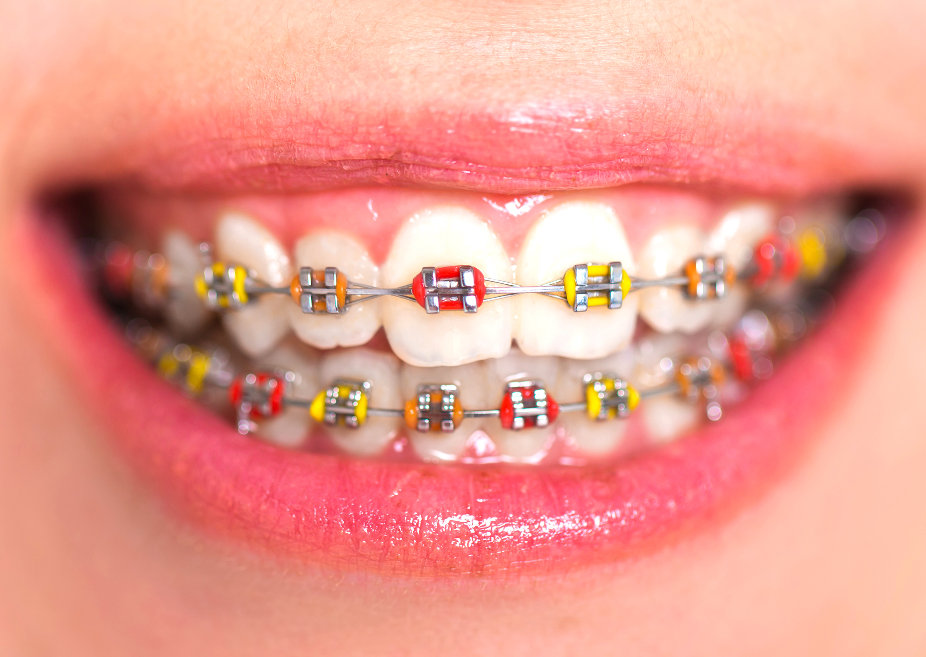 teeth with braces