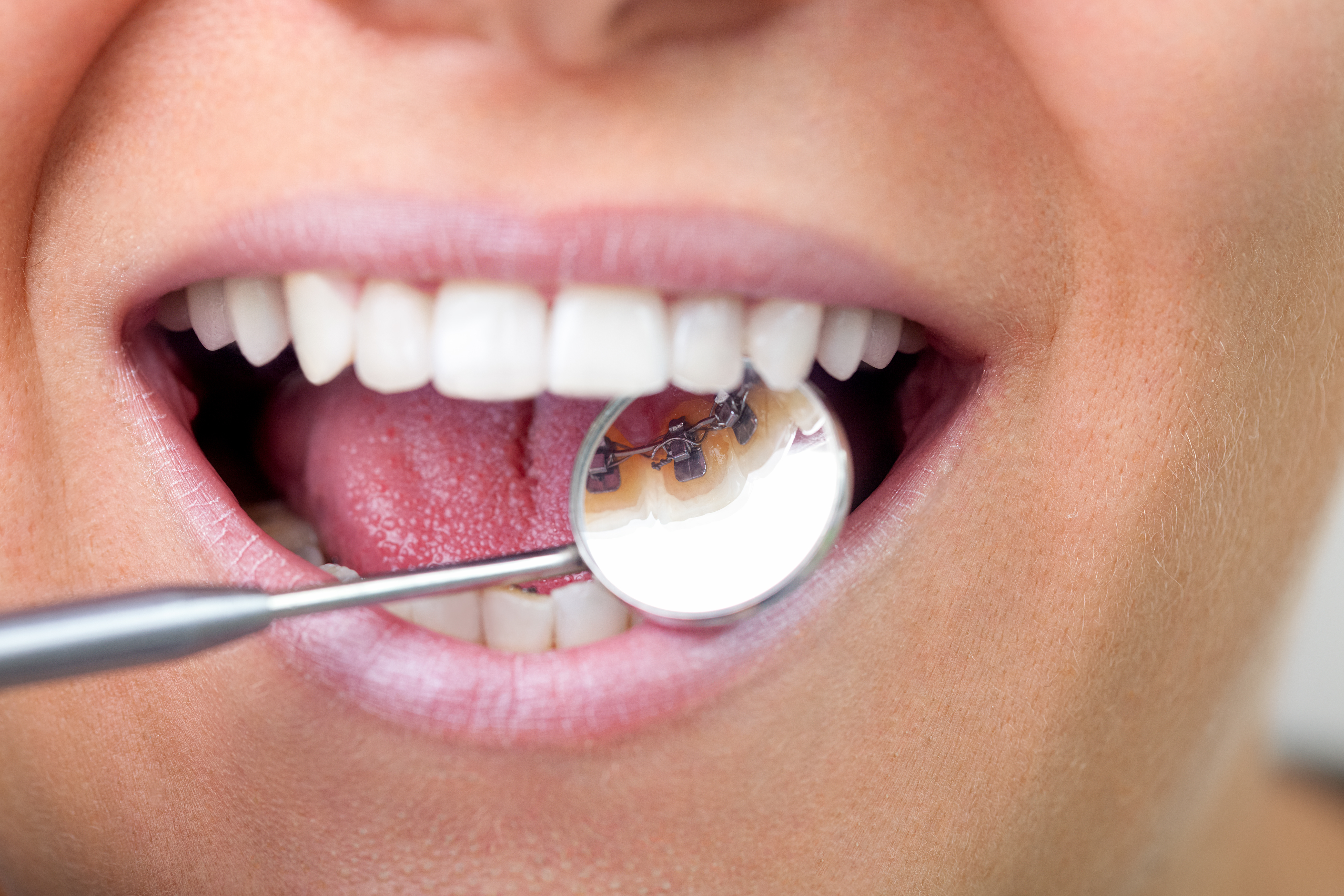 lingual braces 