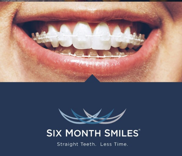 Six Month Smile