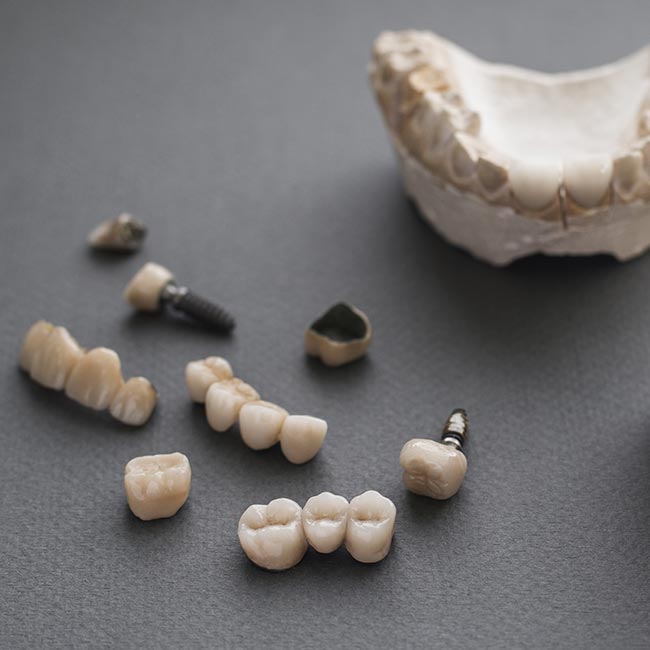 dental implants