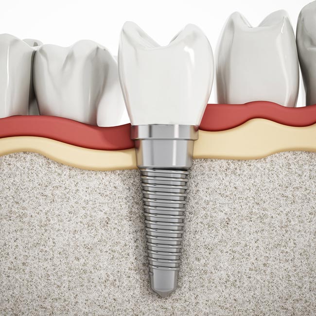dental implant