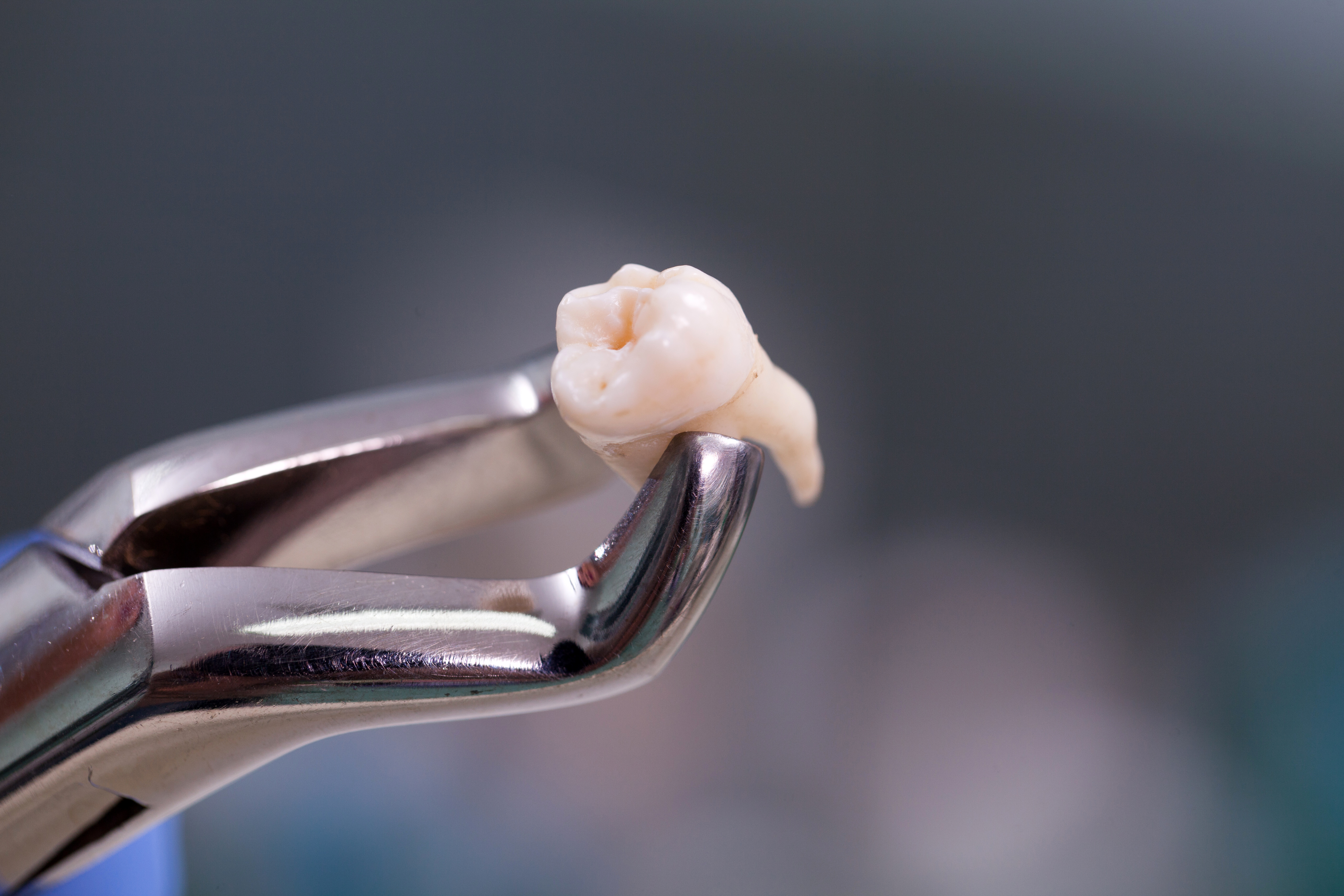 Tooth extracted
