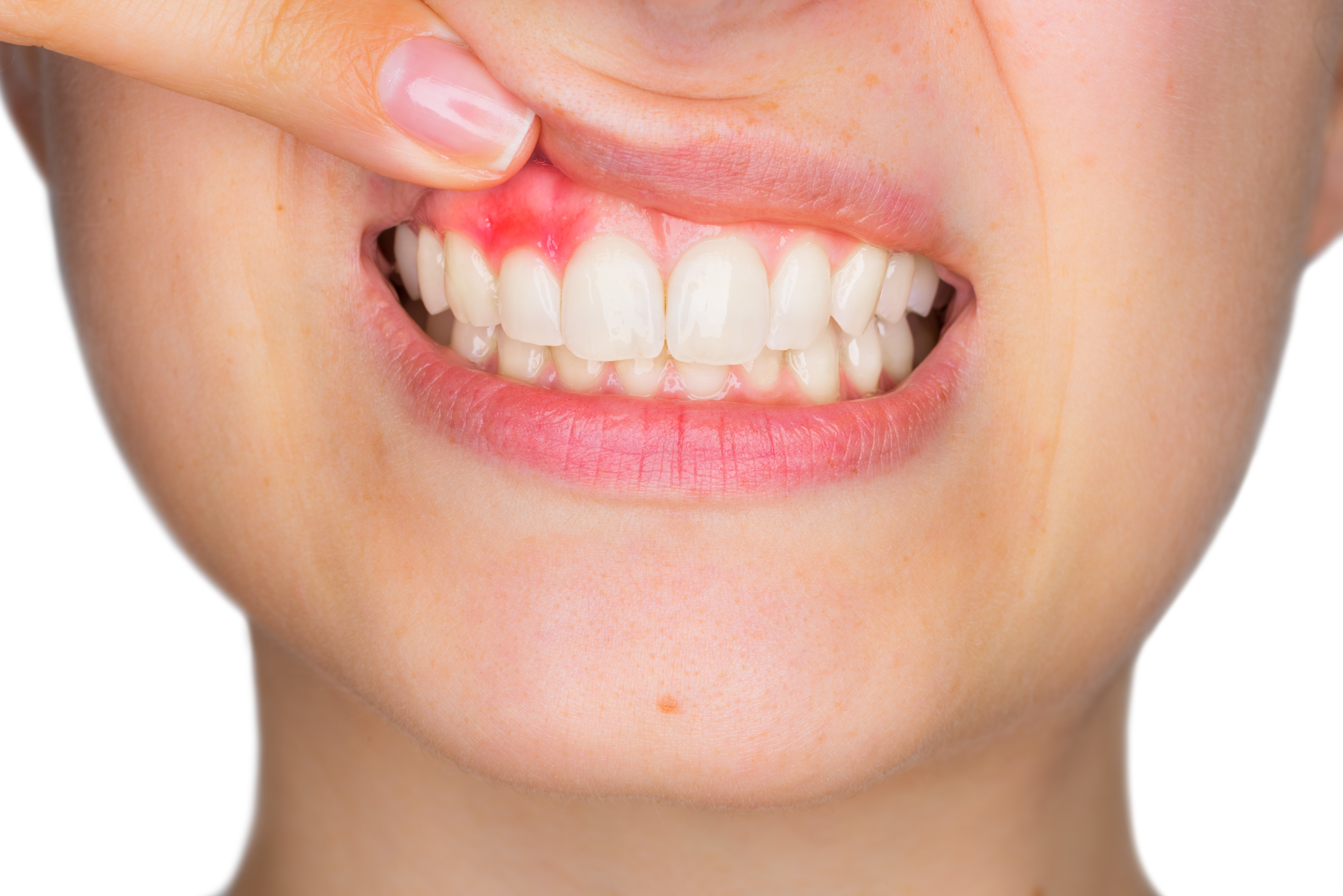 gum disease swollen red gums